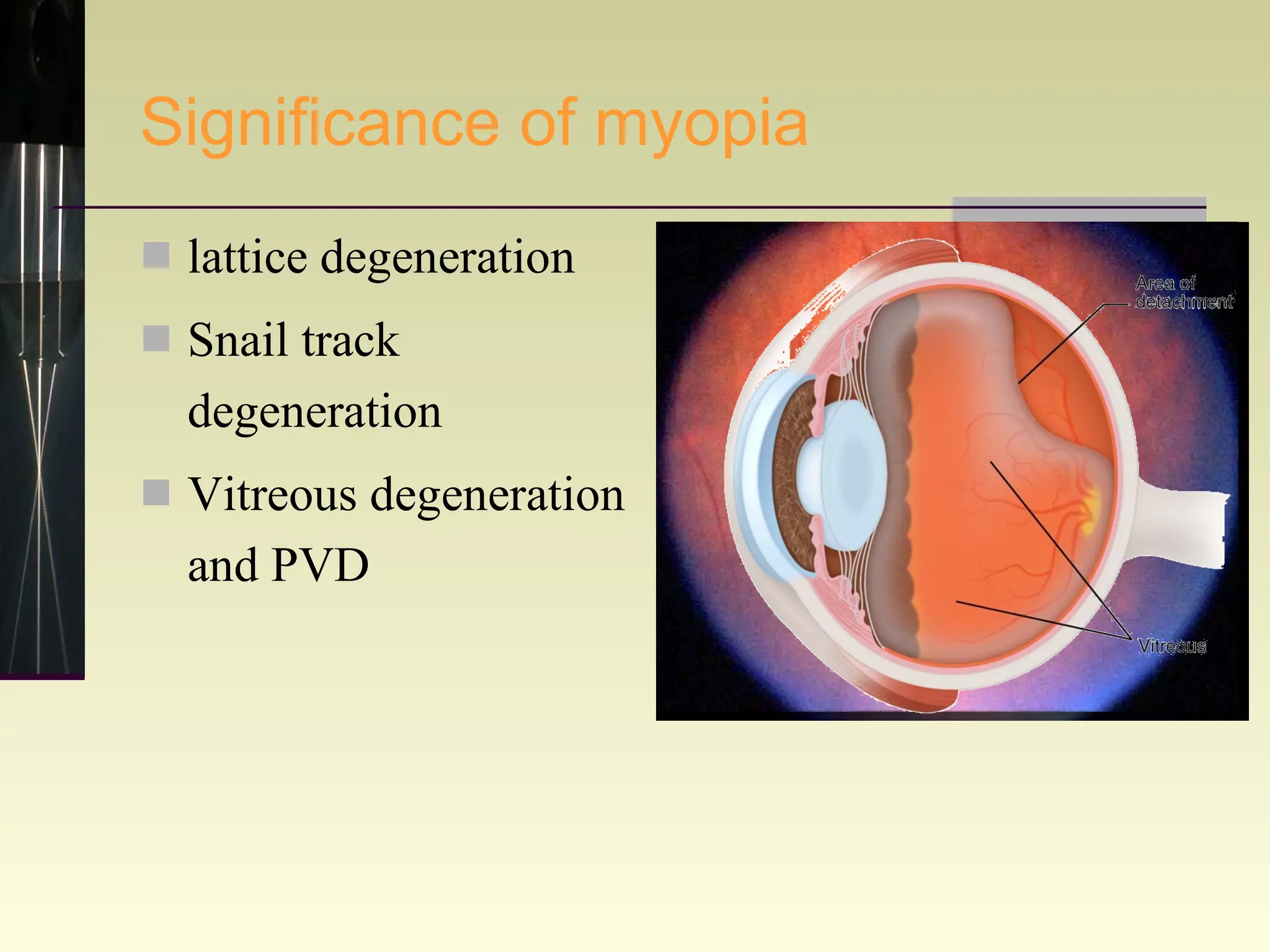 Significance of myopia lattice degeneration  Snail track degeneration Vitreous degeneration and PVD 