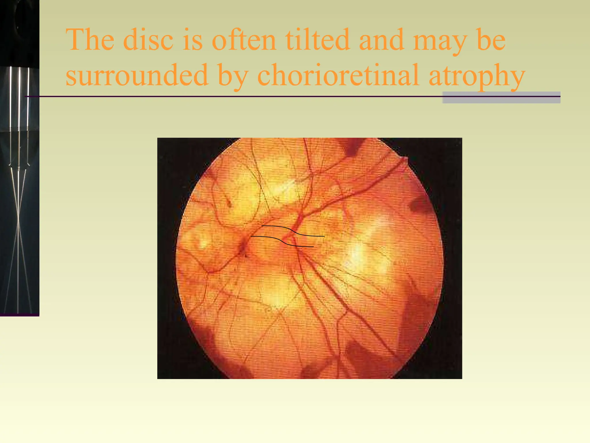 The disc is often tilted and may be surrounded by chorioretinal atrophy 