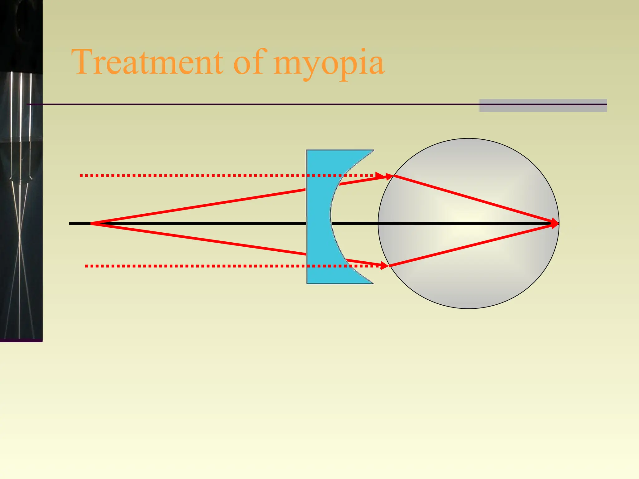 Treatment of myopia 
