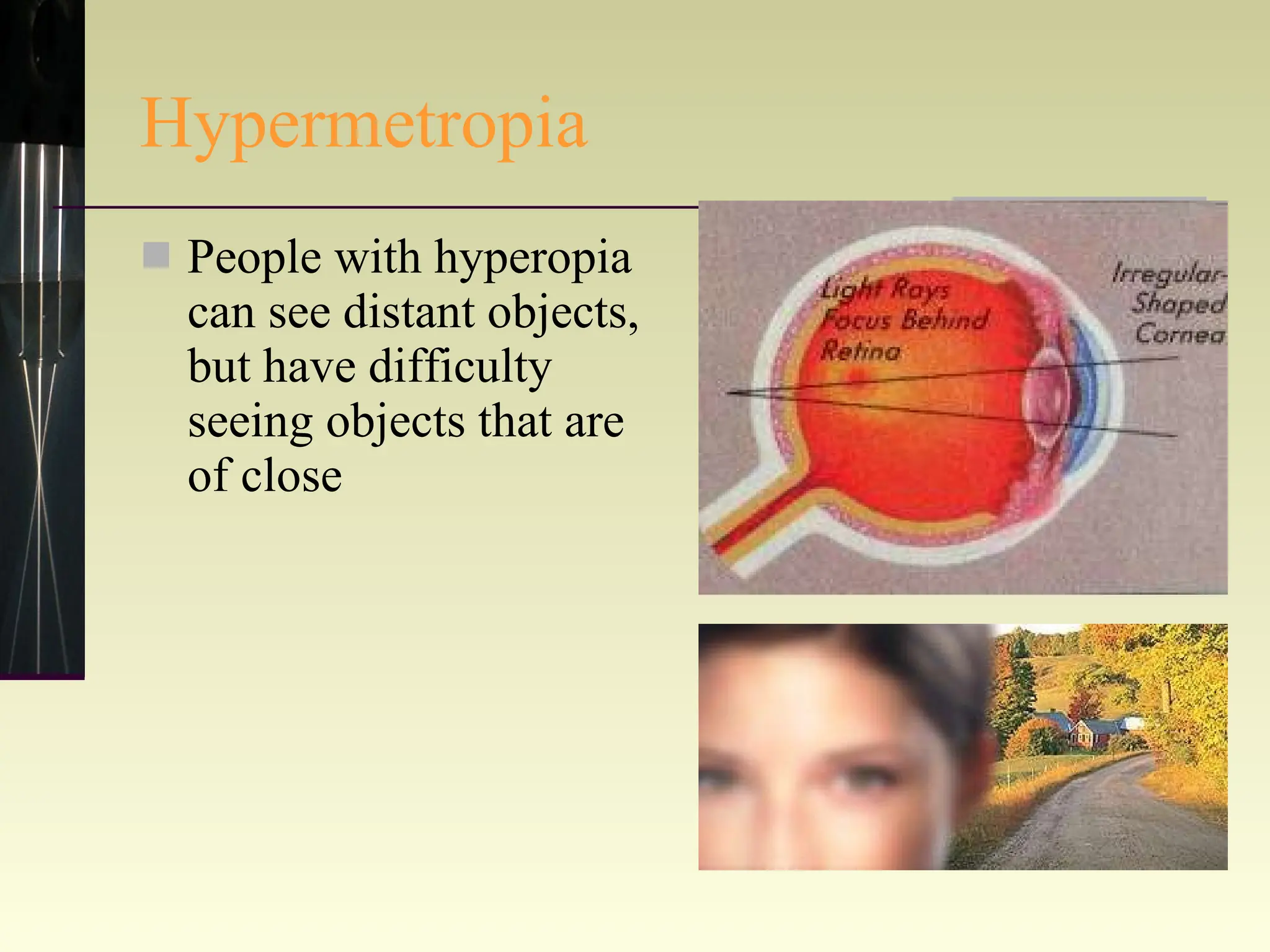 Hypermetropia People with hyperopia can see distant objects, but have difficulty seeing objects that are of close 