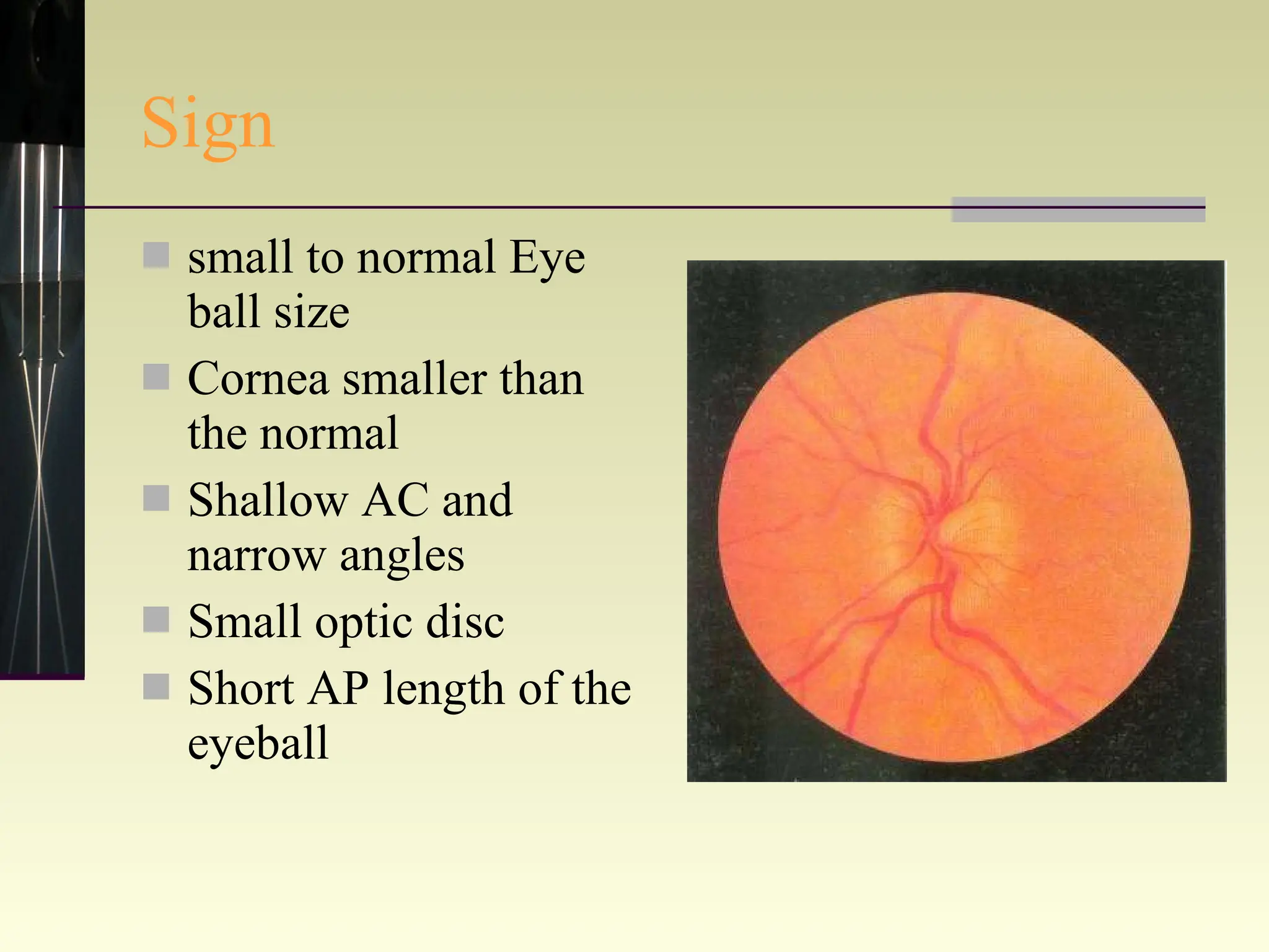 Sign small to normal Eye ball size Cornea smaller than the normal Shallow AC and narrow angles Small optic disc Short AP length of the eyeball 