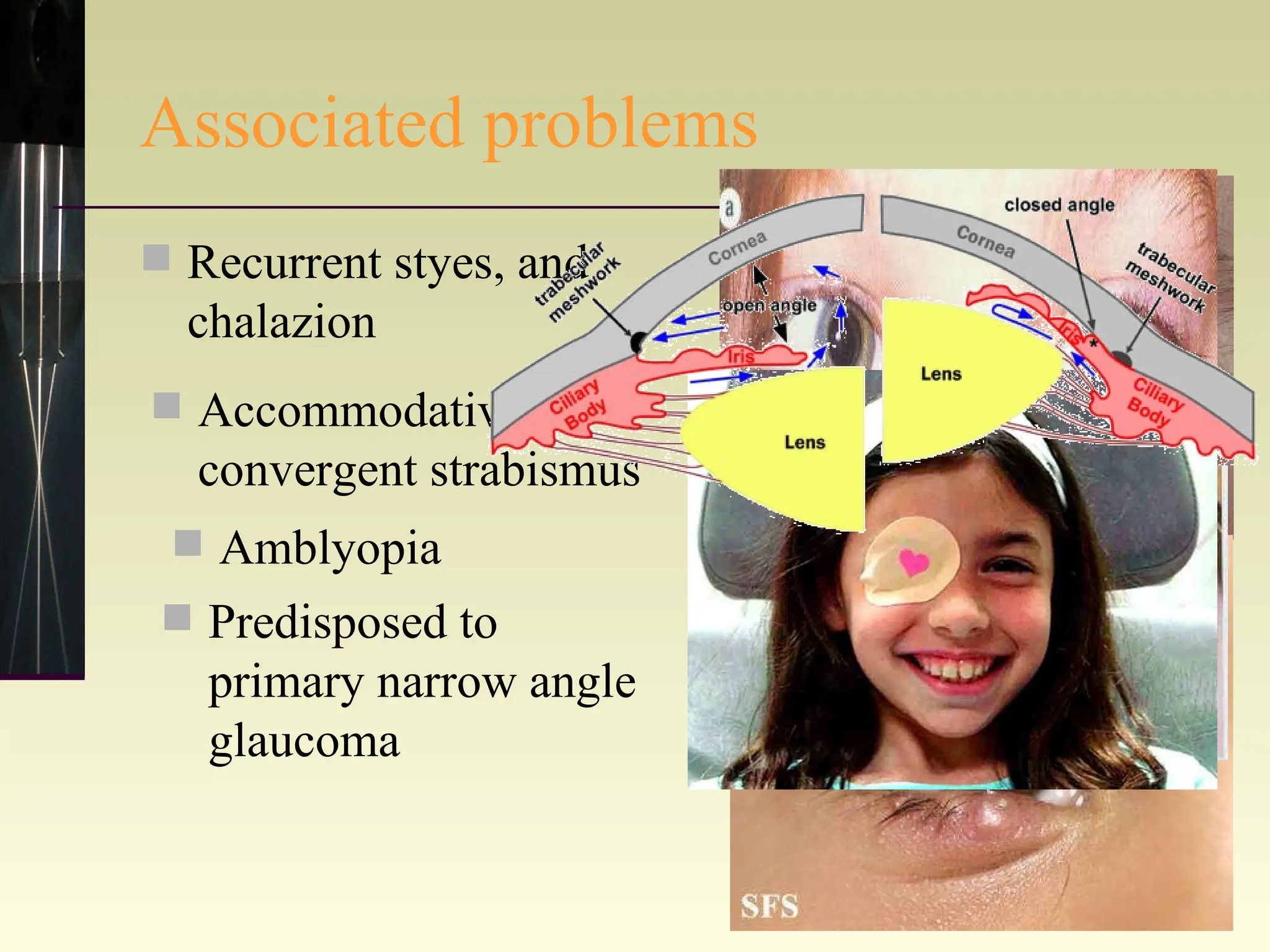 Associated problems Recurrent styes, and chalazion Accommodative convergent strabismus Amblyopia Predisposed to primary narrow angle glaucoma 