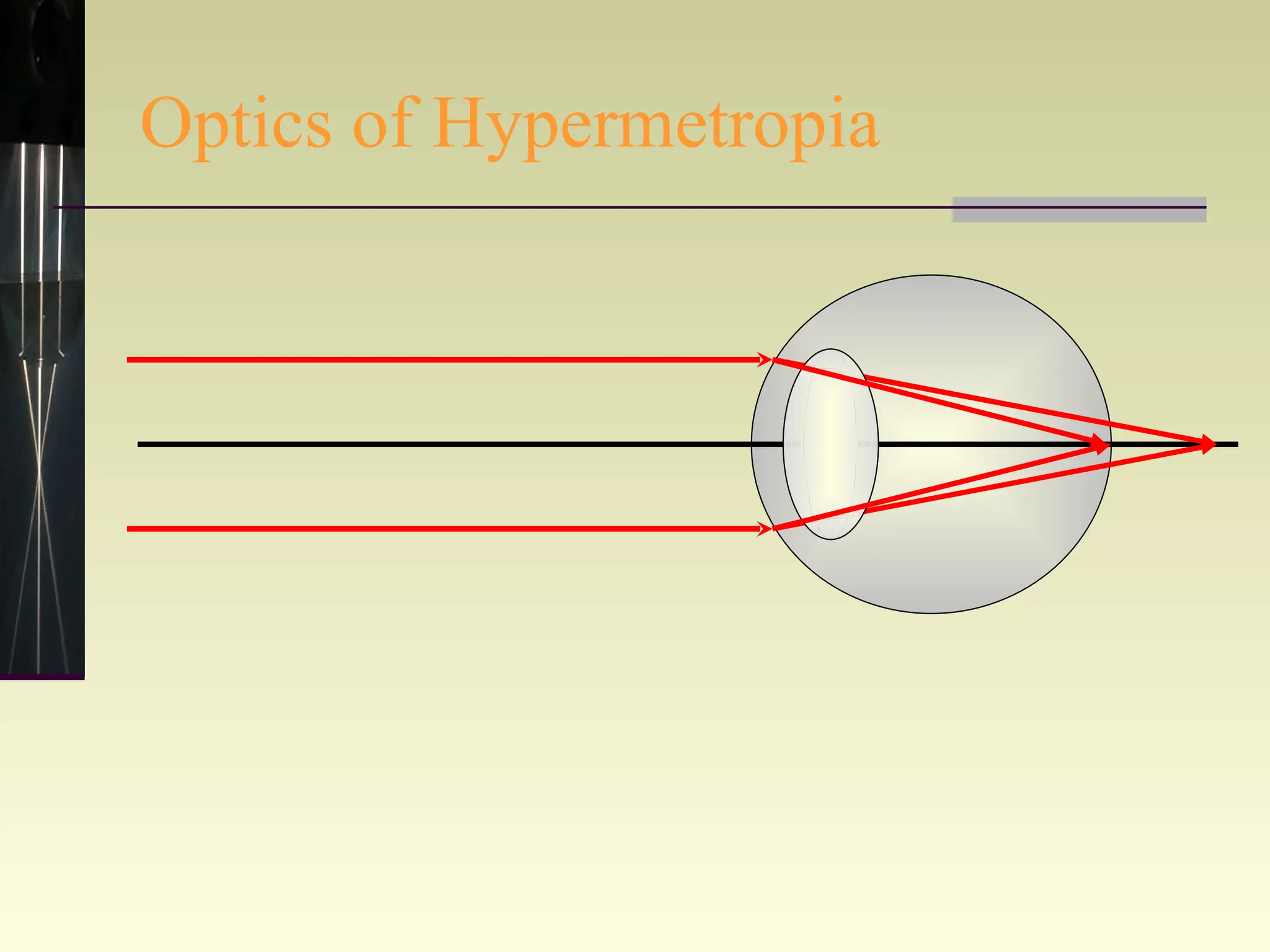 Optics of Hypermetropia 