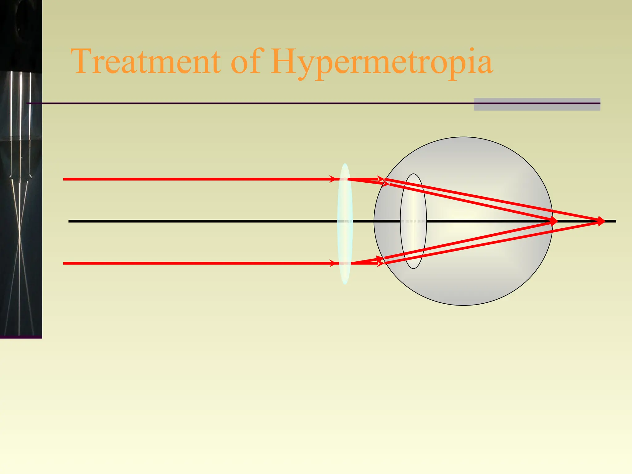 Treatment of Hypermetropia 