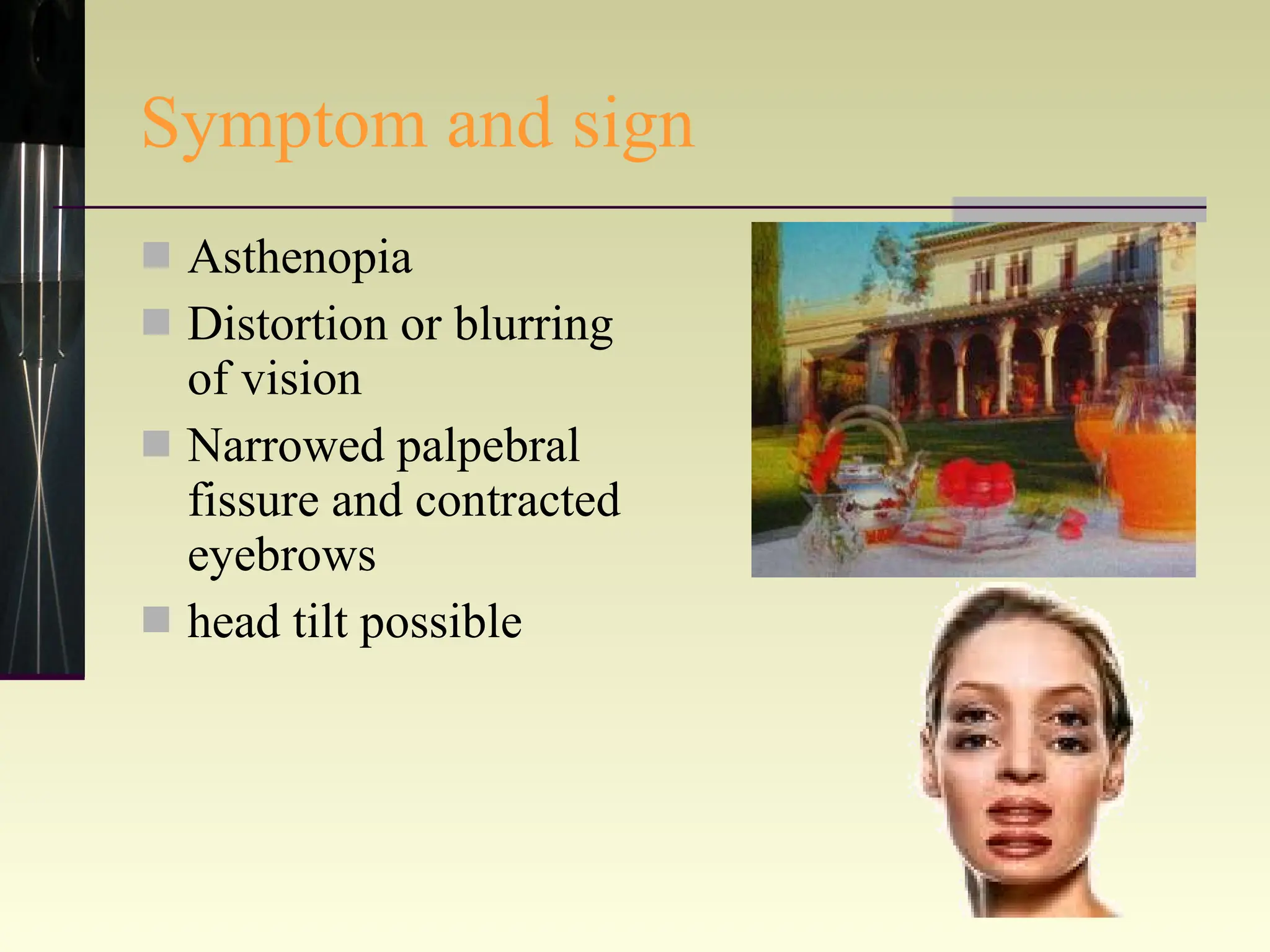 Symptom and sign Asthenopia Distortion or blurring of vision Narrowed palpebral fissure and contracted eyebrows head tilt possible 