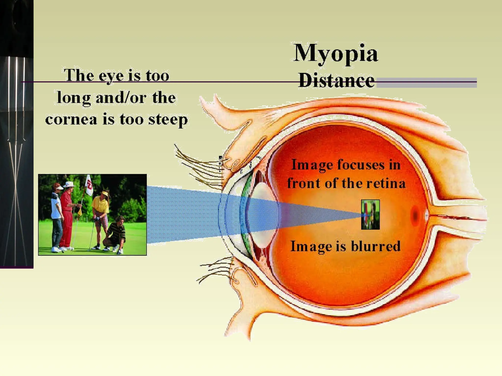 MYOPIA 