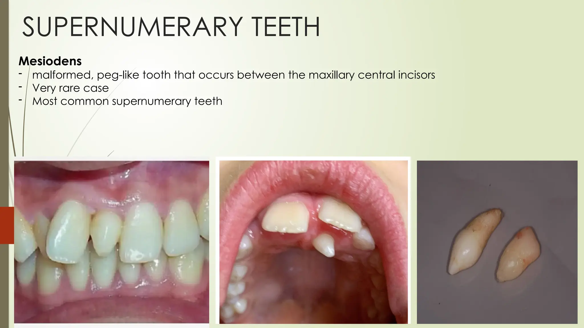 Lr6 Tooth Anomalies of tooth development.ppssssssssssssstx | PPTX