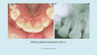 Anomalies of tooth formation and eruption | PPTX