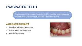 ANOMALIES OF TOOTH FORMATION AND ERUPTION..pptx