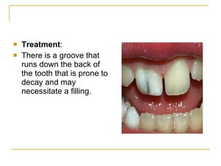 Anomalies of tooth formation & eruption | PPT