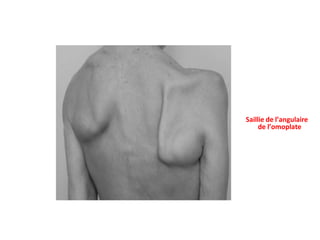 Saillie de l’angulaire
de l’omoplate
 