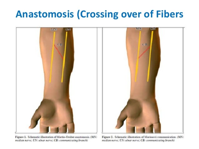 Anomalous Innervations in (EMG/NCS) by Murtaza