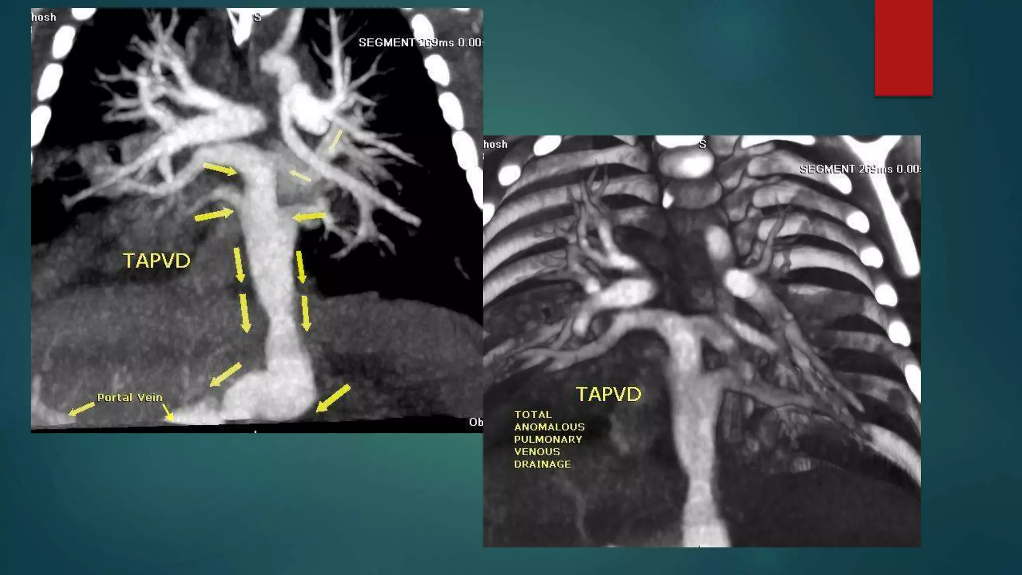 Anomalous pulmonary venous drainage total & partial CT role | PPTX