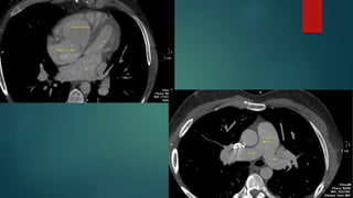 Anomalous pulmonary venous drainage total & partial CT role | PPTX
