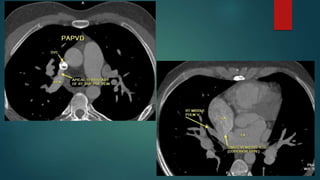 Anomalous pulmonary venous drainage total & partial CT role | PPTX