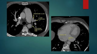 Anomalous pulmonary venous drainage total & partial CT role