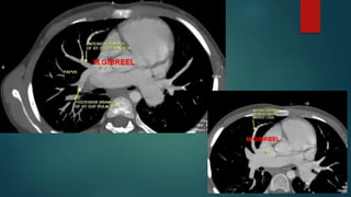 Anomalous pulmonary venous drainage total & partial CT role