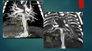  Infracardiac type. A large vertical anastomosis is made between the
common pulmonary venous sinus and the LA. The common...