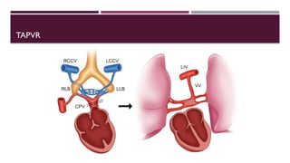ANOMALOUS pulmonary veins circulation congenital heart disease | PPTX