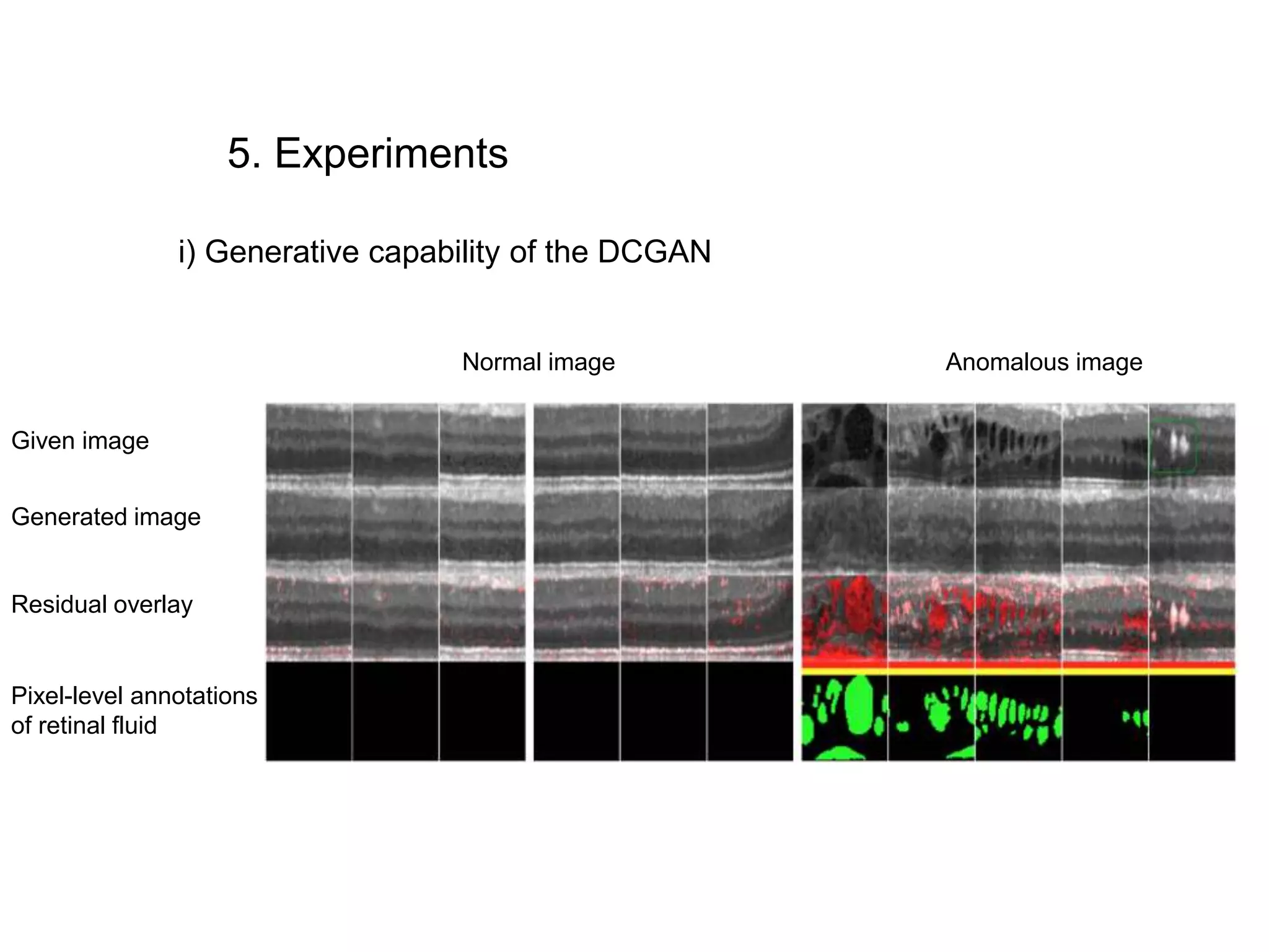 i) Generative capability of the DCGAN 5. Experiments Given image Generated image Residual overlay Pixel-level annotations of retinal fluid Normal image Anomalous image 