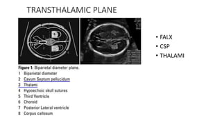 TRANSTHALAMIC PLANE
• FALX
• CSP
• THALAMI
 