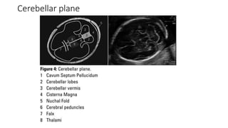 Cerebellar plane
 