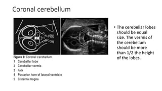 Coronal cerebellum
• The cerebellar lobes
should be equal
size. The vermis of
the cerebellum
should be more
than 1/2 the height
of the lobes.
 