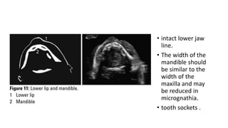 • intact lower jaw
line.
• The width of the
mandible should
be similar to the
width of the
maxilla and may
be reduced in
micrognathia.
• tooth sockets .
 