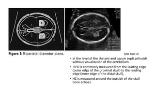 • at the level of the thalami and cavum septi pellucidi
without visualization of the cerebellum.
• BPD is commonly measured from the leading edge
(outer edge of the proximal skull) to the leading
edge (inner edge of the distal skull),
• HC is measured around the outside of the skull
bone echoes.
BPD AND HC
 