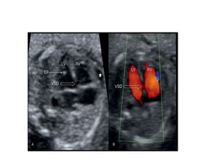 Repeat Anomaly Scan Rates ANOMALY SCAN checklists and abnormalities | PPTX