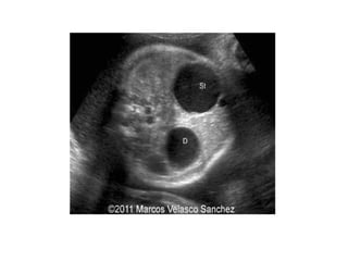 Repeat Anomaly Scan Rates ANOMALY SCAN checklists and abnormalities | PPTX