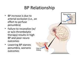 BP Relationship
• BP increase is due to
arterial occlusion (i.e., an
effort to perfuse
penumbra)
• Failure to recanalize (w/
or w/o thrombolytic
therapy) results in high
BP and poor neuro
outcomes
• Lowering BP starves
penumbra, worsens
outcomes
Penumbra
Core
Clot in
Artery
 