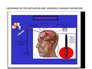 UROKINASE OR TPA INSTILATION AND MINIMALLY INVASIVE ASPIRATION
 