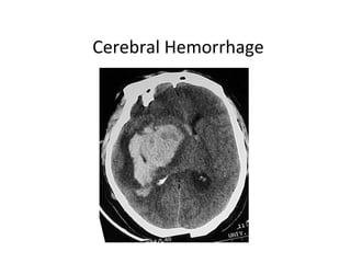 Cerebral Hemorrhage
JPG
 