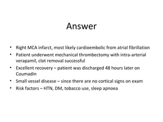 Answer
• Right MCA infarct, most likely cardioembolic from atrial fibrillation
• Patient underwent mechanical thrombectomy with intra-arterial
verapamil, clot removal successful
• Excellent recovery – patient was discharged 48 hours later on
Coumadin
• Small vessel disease – since there are no cortical signs on exam
• Risk factors – HTN, DM, tobacco use, sleep apnoea
 