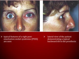  typical features of a right post-
enucleation socket syndrome (PESS)
are seen
 lateral view of the patient
demonstrating a typical
backward tilt to the prosthesis
 