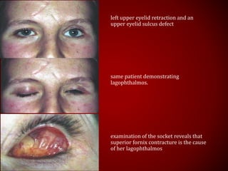 left upper eyelid retraction and an
upper eyelid sulcus defect
same patient demonstrating
lagophthalmos.
examination of the socket reveals that
superior fornix contracture is the cause
of her lagophthalmos
 