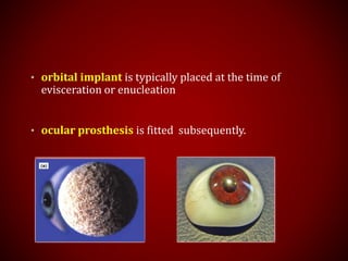 • orbital implant is typically placed at the time of
evisceration or enucleation
• ocular prosthesis is fitted subsequently.
 