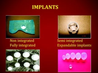 Non integrated Semi integrated
Fully integrated Expandable implants
IMPLANTS
 