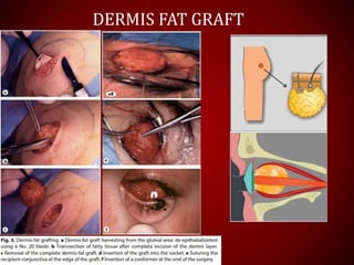 DERMIS FAT GRAFT
 