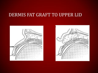 DERMIS FAT GRAFT TO UPPER LID
 