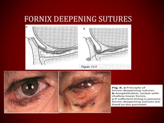 FORNIX DEEPENING SUTURES
 