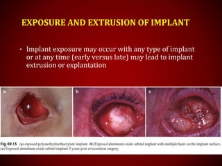 EXPOSURE AND EXTRUSION OF IMPLANT
• Implant exposure may occur with any type of implant
or at any time (early versus late) may lead to implant
extrusion or explantation
 