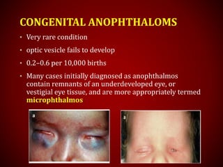 CONGENITAL ANOPHTHALOMS
• Very rare condition
• optic vesicle fails to develop
• 0.2–0.6 per 10,000 births
• Many cases initially diagnosed as anophthalmos
contain remnants of an underdeveloped eye, or
vestigial eye tissue, and are more appropriately termed
microphthalmos
 