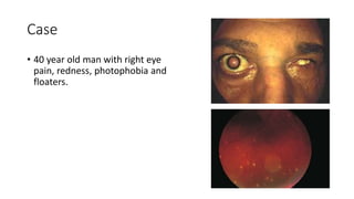 Case
• 40 year old man with right eye
pain, redness, photophobia and
floaters.
 