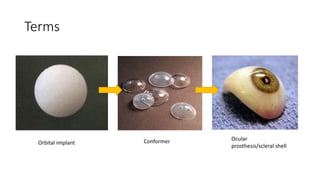 Terms
Orbital implant Conformer Ocular
prosthesis/scleral shell
 