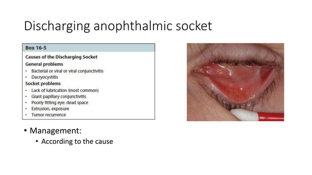Anophthalmic socket (evisceration, enucleation, exenteration) | PPTX ...