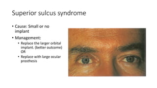Superior sulcus syndrome
• Cause: Small or no
implant
• Management:
• Replace the larger orbital
implant. (better outcome)
OR
• Replace with large ocular
prosthesis
 
