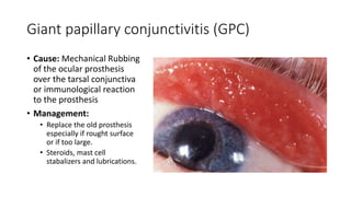 Giant papillary conjunctivitis (GPC)
• Cause: Mechanical Rubbing
of the ocular prosthesis
over the tarsal conjunctiva
or immunological reaction
to the prosthesis
• Management:
• Replace the old prosthesis
especially if rought surface
or if too large.
• Steroids, mast cell
stabalizers and lubrications.
 
