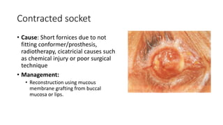 Contracted socket
• Cause: Short fornices due to not
fitting conformer/prosthesis,
radiotherapy, cicatricial causes such
as chemical injury or poor surgical
technique
• Management:
• Reconstruction using mucous
membrane grafting from buccal
mucosa or lips.
 